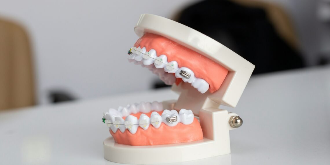 Cracking The Cost Code: Full Mouth Dental Implants Unveiled 1 Full Mouth Dental Implants Cost