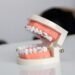 Cracking The Cost Code: Full Mouth Dental Implants Unveiled 8 Full Mouth Dental Implants Cost