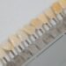 Choosing Wisely: Dental Implants Vs. Dentures For A Lasting Solution 8 Dental Implants Vs Dentures