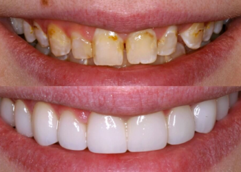 Revealing The Beauty Within: Veneers Before And After Photos 7 Veneers Before And After