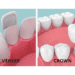 Veneers Vs. Crowns: Achieving Perfection For Your Teeth 8 Veneers Vs. Crowns
