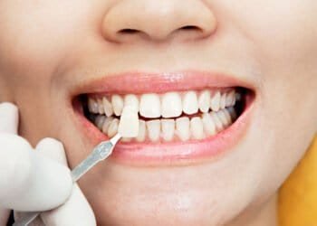 Unleash The Power Of Veneers: How Long Can They Last? 7 How Long Do Veneers Last