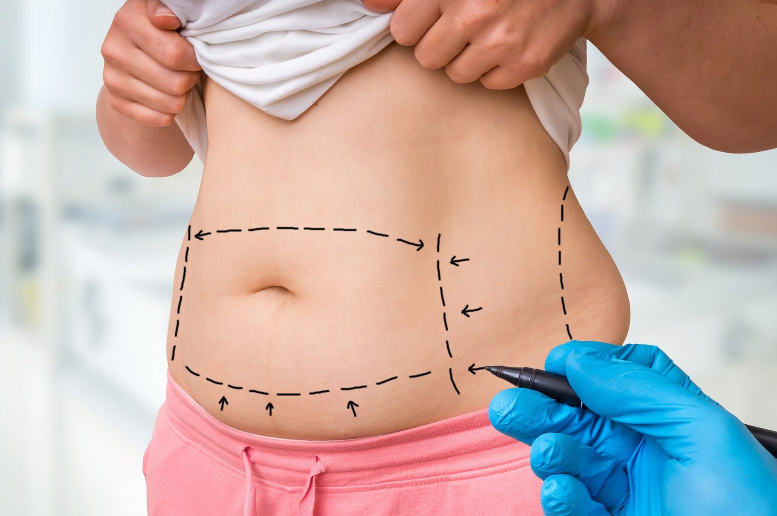 Helpful Questions On Coolsculpting In San Diego