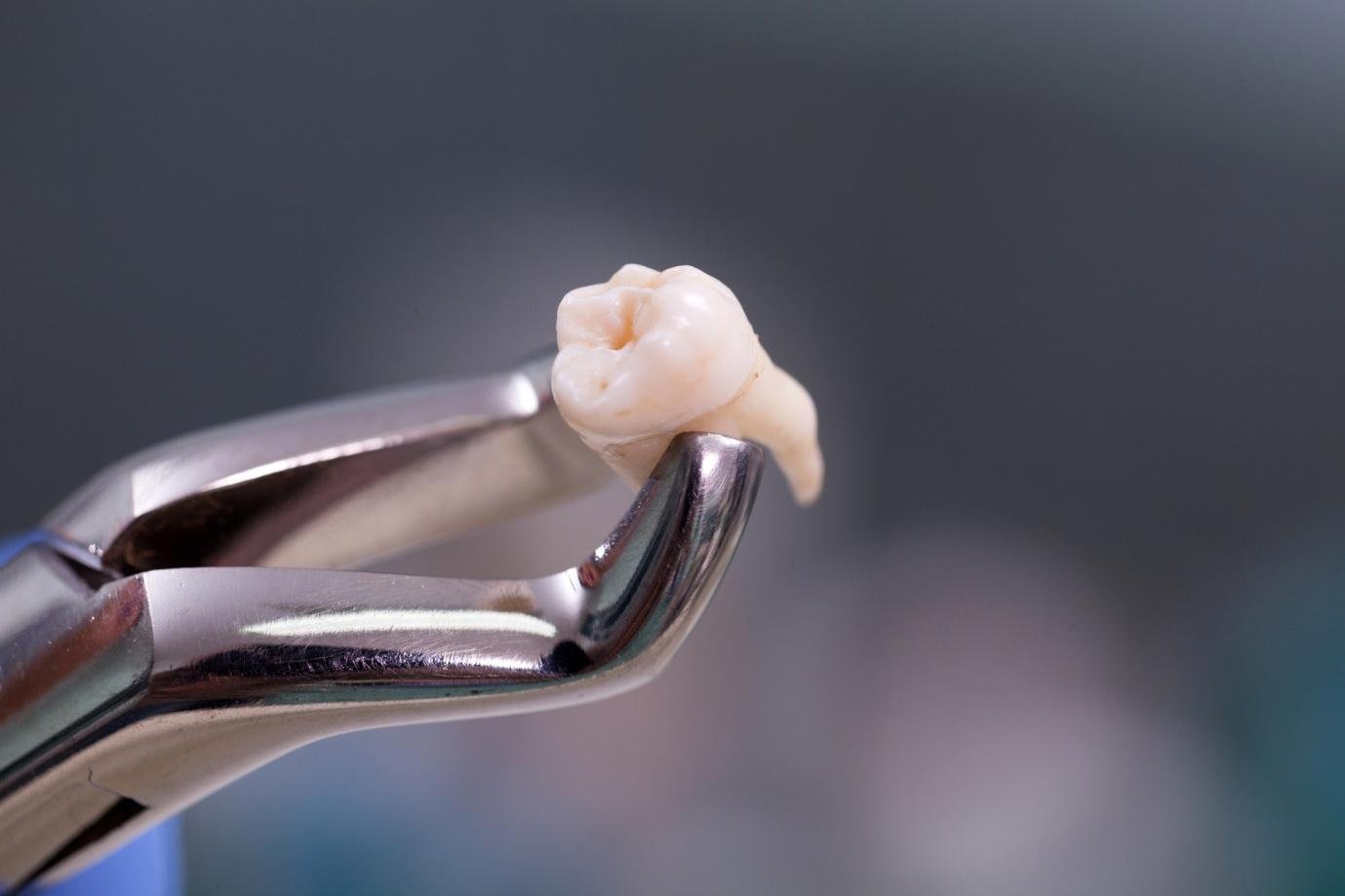 The Possible Solutions For Missing Teeth