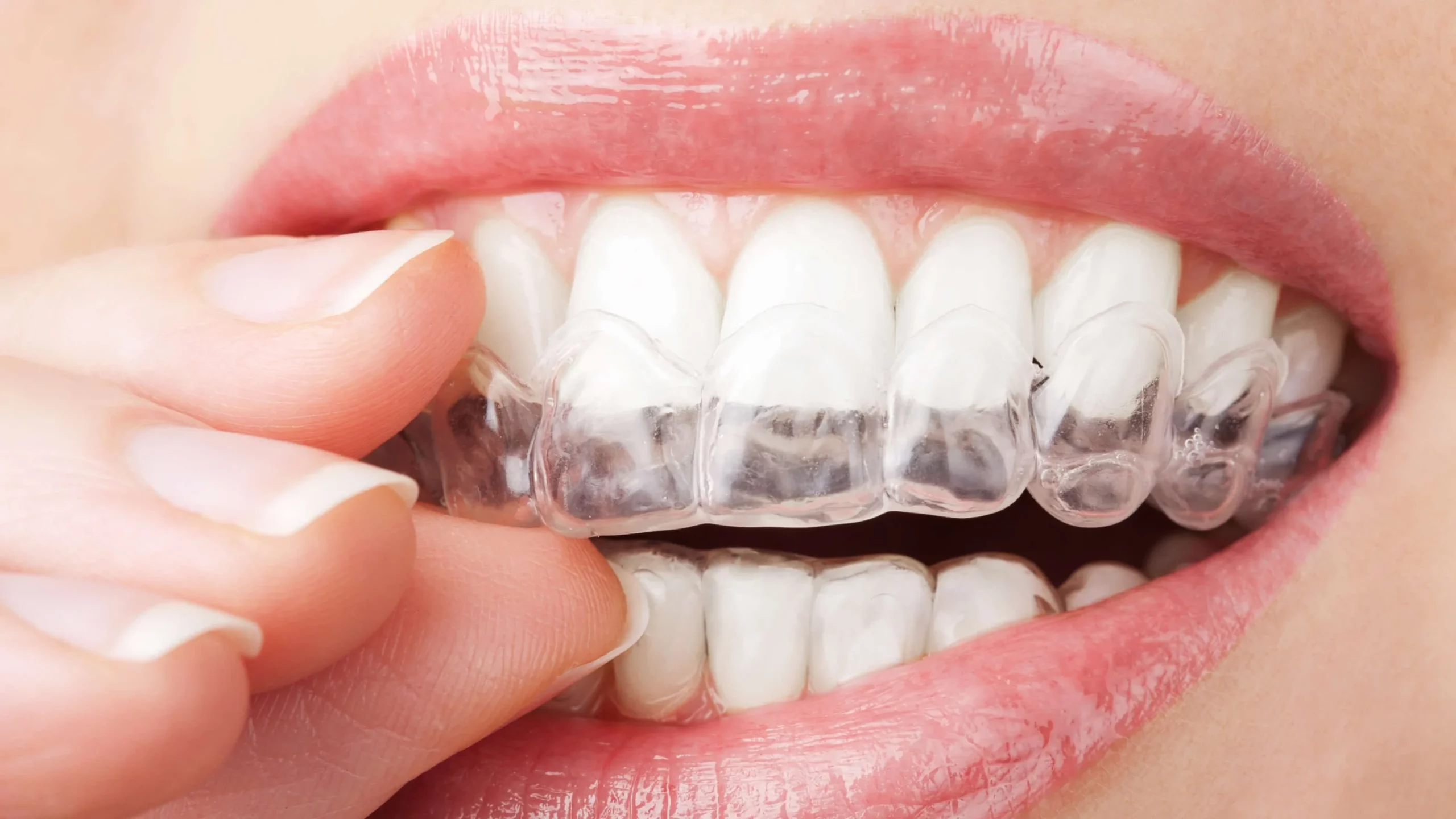 Unveiling The Power Of Invisalign In Cloverdale