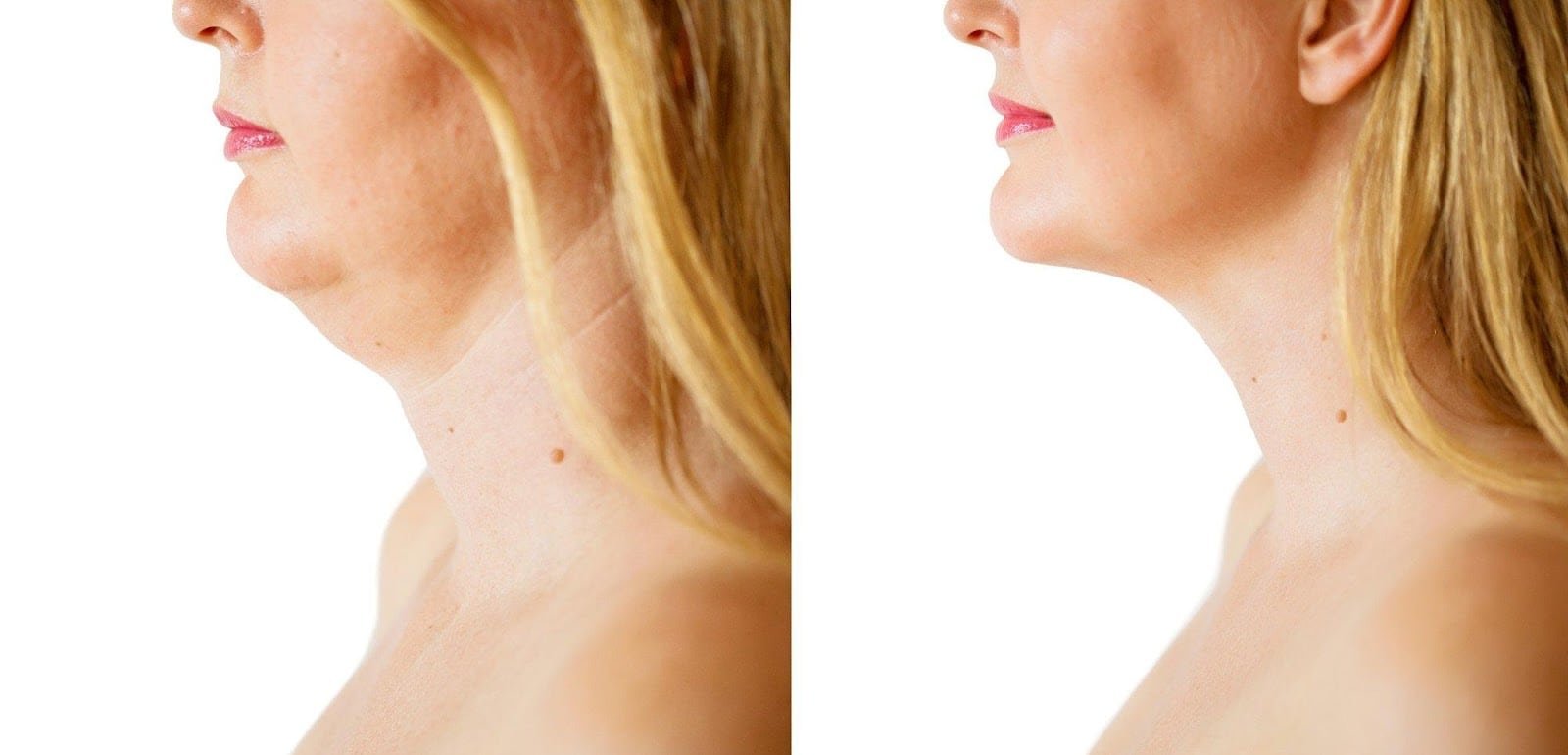 Am I A Good Candidate For Neck Liposuction Find Out Here