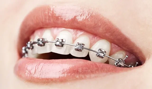 The Benefits Of Cosmetic Braces Why They'Re More Than Just A Pretty Smile