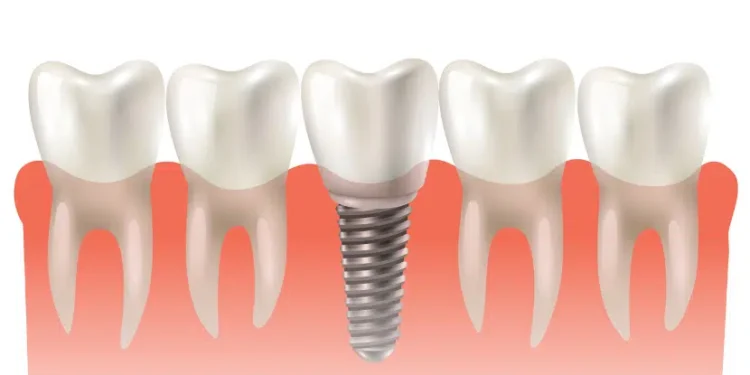Benefits Of Dental Implants: The Best Choice For Tooth Replacement 1