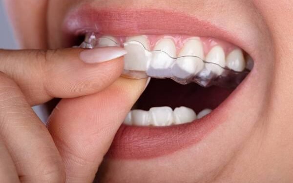 The Role Of Orthodontics In Achieving Proper Teeth Alignment