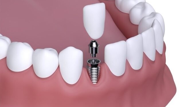 Common Misconceptions About Dental Implants: Busted 1