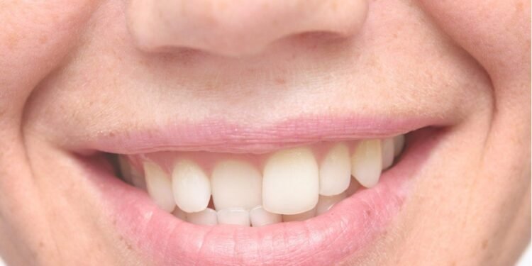 The Difference Between Overbite Vs Underbite: Causes And Treatment Options