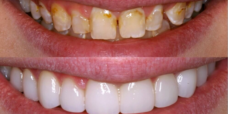 Veneers Before And After