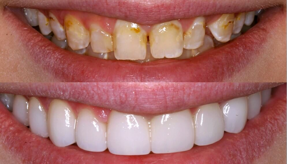 Veneers Before And After