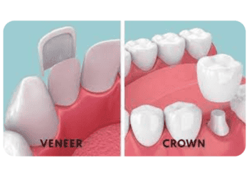 Veneers Vs. Crowns