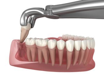 Wisdom Teeth Extraction