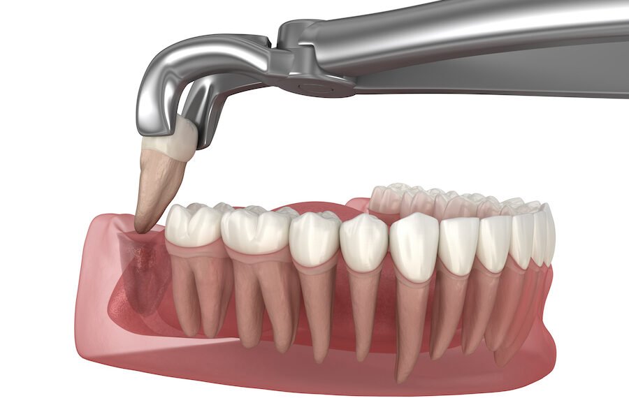 Wisdom Teeth Extraction