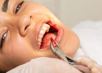 Wisdom Teeth Removal Cost