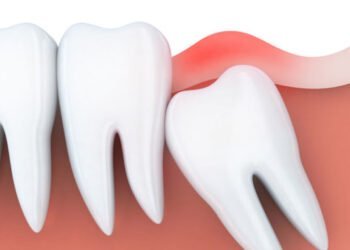 Wisdom Teeth Removal Aftercare